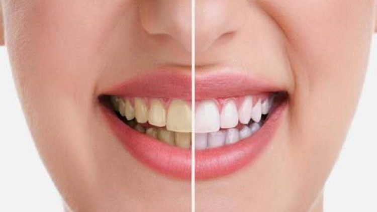 Albirea vitala – una dintre cele mai folosite proceduri de cosmetica dentara